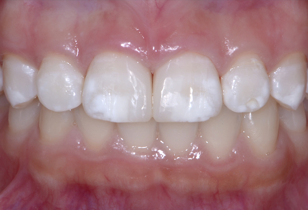 ダイレクトボンディングの前歯(すきっ歯)即日治療写真