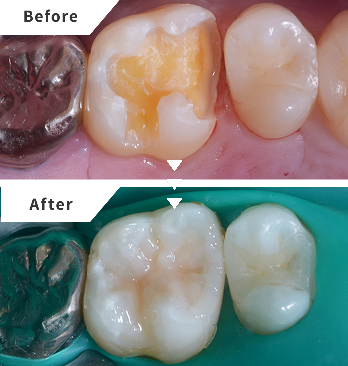 ダイレクトボンディングによる即日虫歯治療